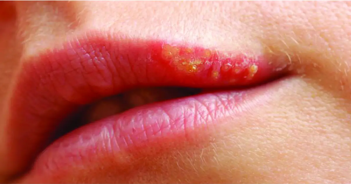 Pequeños puntos blancos en los labios: Causas y Tratamiento | ElUtil